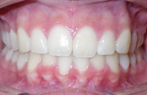 deep overbite during
